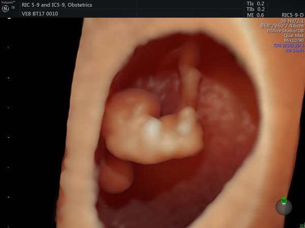 تصویر سه بعدی جنین 9 هفته