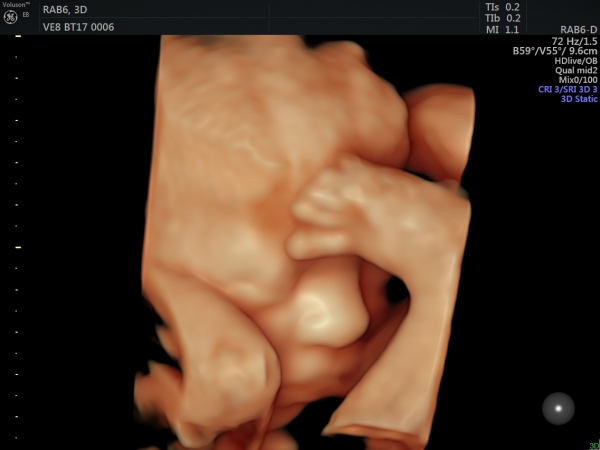 تصویر سه بعدی جنین