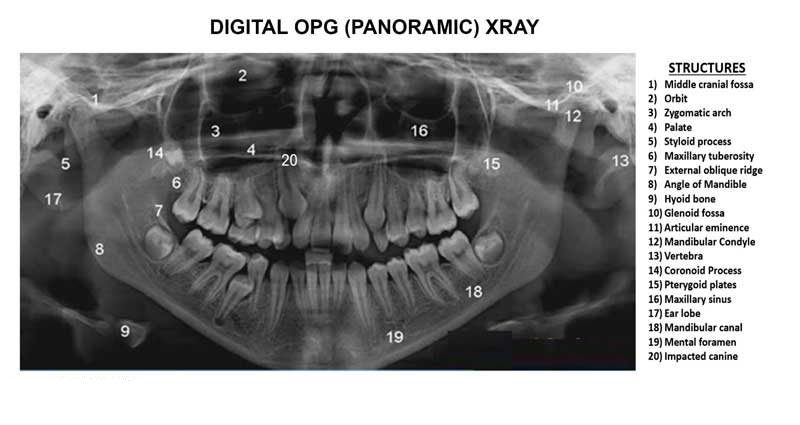 OPG در دندانپزشکی چیست؟ | عکس پانورکس دندان